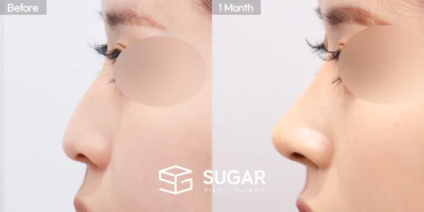슈가성형외과 첫) 콧대 + 코끝 + 매부리코 + 귀연골 전후사진 - 측면 수술 전후 비교
