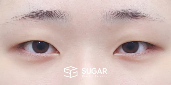 슈가성형외과 첫) 절개 + 윗트임 전후사진 - 수술 전