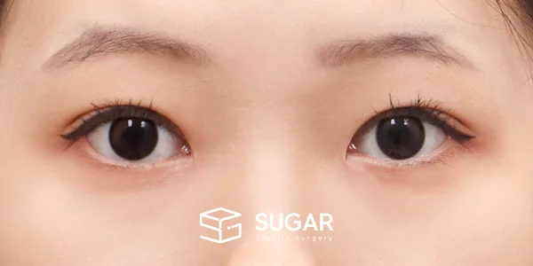 슈가성형외과 첫) 자연유착 + 눈매교정 + 앞트임 전후사진 - 수술 후