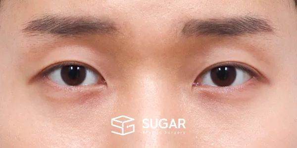 슈가성형외과 첫) 자연유착 + 눈매교정 전후사진 - 수술 후