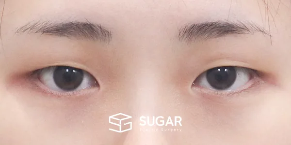 슈가성형외과 첫) 자연유착 + 눈매교정 전후사진 - 수술 전