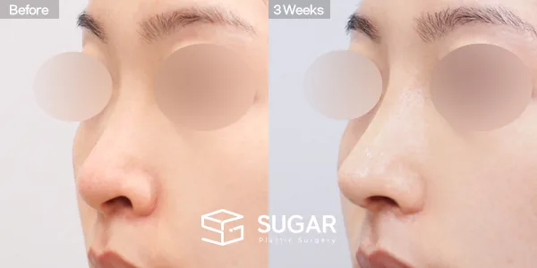 슈가성형외과 첫) 콧대 + 코끝 + 복코 + 비공 내리기 + 절골 + 귀연골 전후사진 - 45도 수술 전후 비교