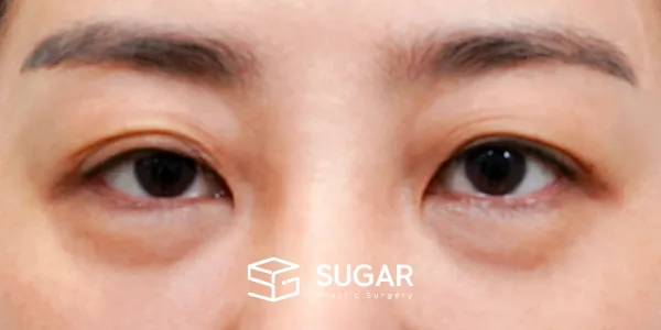 슈가성형외과 첫) 눈썹 거상 + 중안면부 거상 + 하안검 + 자연유착 전후사진 - 수술 전