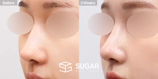 슈가성형외과 재) 재수술 + 매부리코 + 비공 내리기 + 귀 뒤 근막 전후사진 - 45도 수술 전후 비교