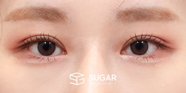 슈가성형외과 첫) 자연유착 + 눈매교정 전후사진 - 수술 후