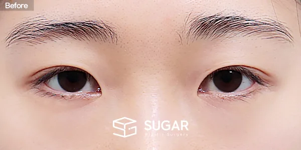 슈가성형외과 재) 재수술 + 뒤밑트임 전후사진 - 수술 전