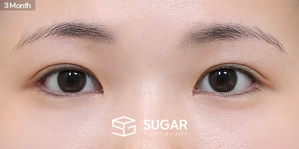 슈가성형외과 재) 뒤트임 재수술 + 밑트임 + 눈밑지방재배치 전후사진 - 수술 후
