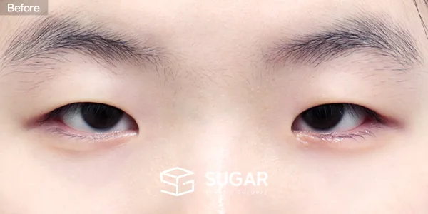 슈가성형외과 첫) 자연유착 + 눈매교정 + 앞트임 전후사진 - 수술 전