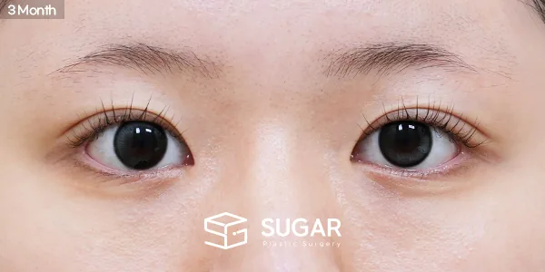 슈가성형외과 첫) 절개 + 눈매교정 + 앞트임 + 윗트임 전후사진 - 수술 후