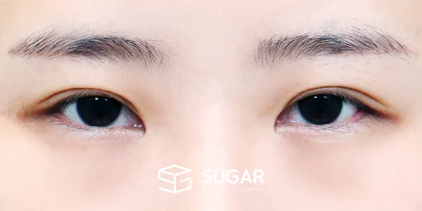 슈가성형외과 첫) 눈밑지방재배치 + 뒤밑트임 전후사진 - 수술 전