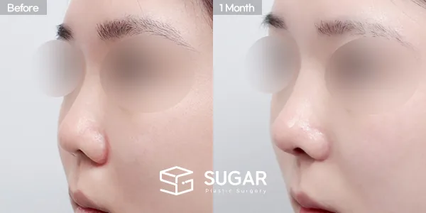 슈가성형외과 첫) 콧대+코끝+짧은코+복코+기증늑+귀연골 전후사진 - 45도 수술 전후 비교