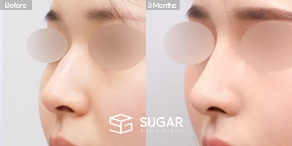 슈가성형외과 첫) 콧대 + 코끝 + 휜코 + 매부리코 + 절골 + 비주 근육 절제 + 귀연골 전후사진 - 45도 수술 전후 비교