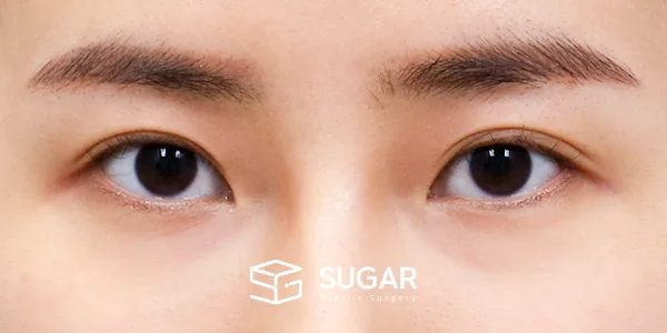 슈가성형외과 첫) 자연유착 + 눈매교정 + 윗트임 + 뒤밑트임 전후사진 - 수술 전