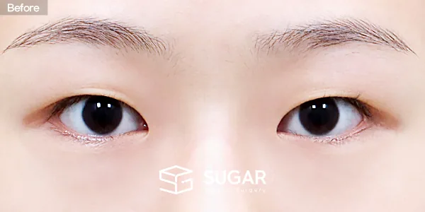 슈가성형외과 첫) 자연유착 + 눈매교정 전후사진 - 수술 전