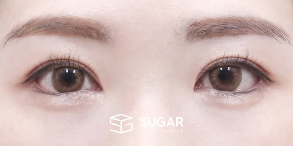 슈가성형외과 재) 재수술 + 상안검 + 뒤밑트임 전후사진 - 수술 후