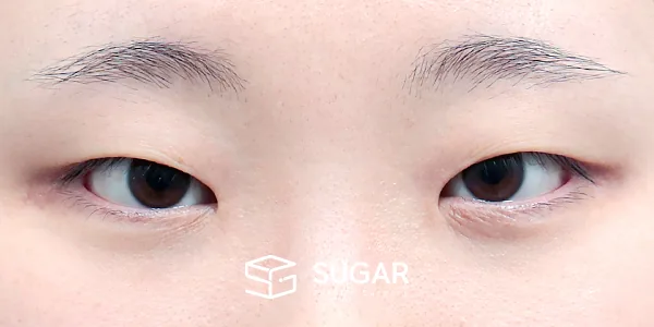 슈가성형외과 첫) 자연유착 + 눈매교정 + 앞트임 전후사진 - 수술 전