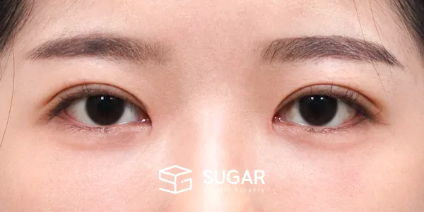 슈가성형외과 첫) 자연유착 + 눈매교정 + 앞트임 + 윗트임 전후사진 - 수술 후