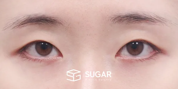 슈가성형외과 첫) 자연유착 + 눈매교정 + 뒤밑트임 전후사진 - 수술 전