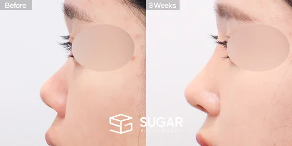 슈가성형외과 첫) 콧대 + 코끝 + 복코 + 코 선반 교정 + 귀연골 전후사진 - 측면 수술 전후 비교