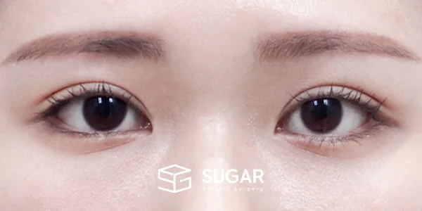 슈가성형외과 첫) 자연유착 + 눈매교정 전후사진 - 수술 후