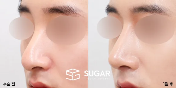 슈가성형외과 첫) 콧대코끝 + 매부리 + 휜코 + 절골 + 비중격 연장 전후사진 - 45도 수술 전후 비교