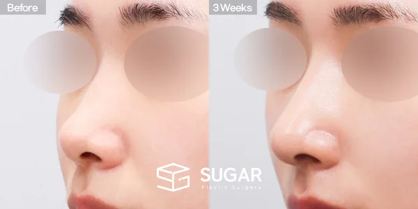 슈가성형외과 첫) 콧대 + 코끝 + 매부리코 + 절골 + 비중격 + 귀연골 전후사진 - 45도 수술 전후 비교