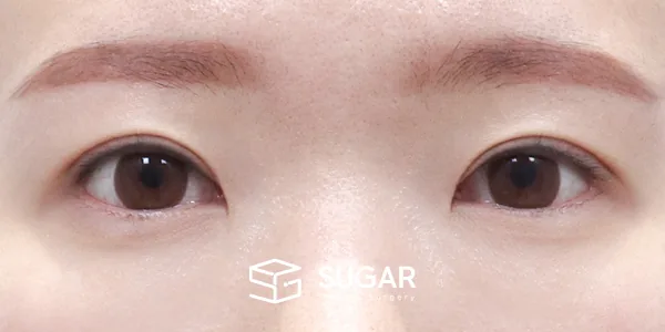 슈가성형외과 재) 재수술 + 절개 + 눈매교정 + 윗트임 전후사진 - 수술 후