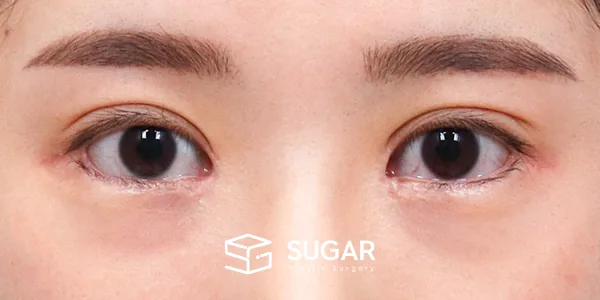 슈가성형외과 재) 재수술 + 절개(두 줄 따기) + 눈 밑 지방재배치 + 뒤밑트임 + 앞트임 복원 흉터 주사 전후사진 - 수술 전