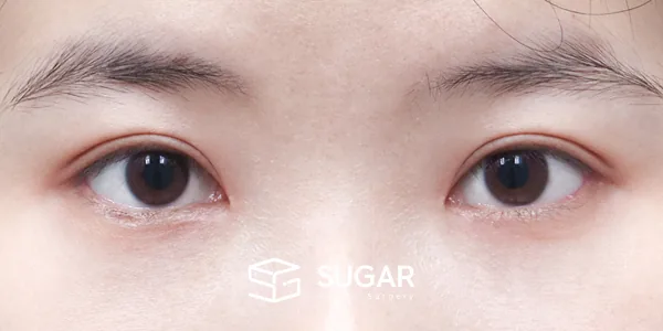 슈가성형외과 첫) 절개 + 눈매교정 + 앞트임 + 뒤밑트임 전후사진 - 수술 후