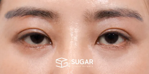 슈가성형외과 첫) 눈썹 거상 + 중안면부 거상 + 하안검 + 자연유착 전후사진 - 수술 후