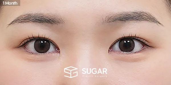슈가성형외과 첫) 뒤밑트임 전후사진 - 수술 후
