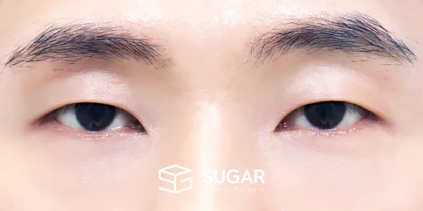 슈가성형외과 첫) 눈밑지방재배치 전후사진 - 수술 후
