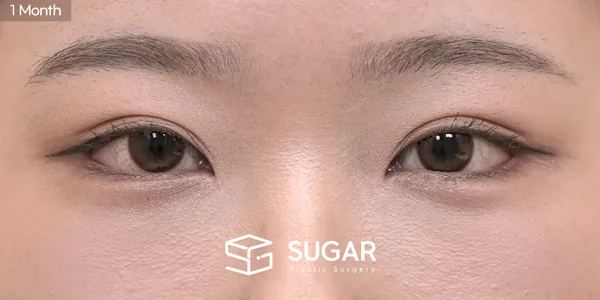슈가성형외과 첫) 뒤트임 + 밑트임 + 눈밑지방재배치 전후사진 - 수술 후