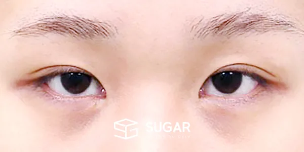 슈가성형외과 재) 재수술 + 자연유착 + 뒤밑트임 전후사진 - 수술 전