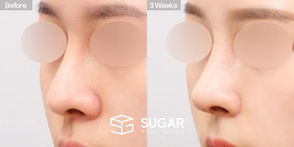슈가성형외과 재) 재수술 + 매부리코 + 휜코 + 비공 내리기 + 비중격 전후사진 - 45도 수술 전후 비교