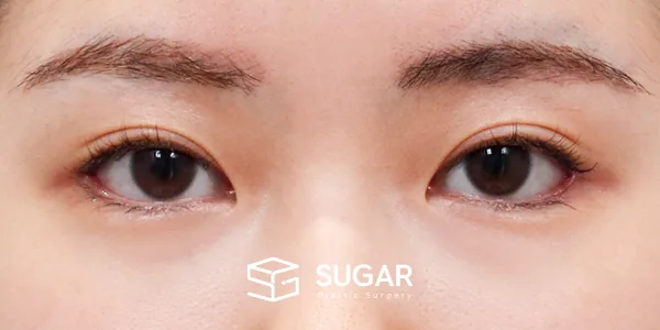 슈가성형외과 재) 재수술 + 뒤밑트임 전후사진 - 수술 후