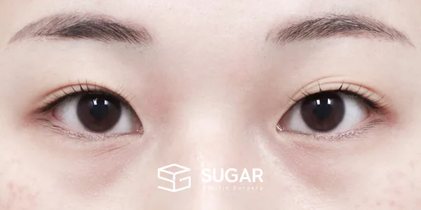 슈가성형외과 첫) 자연유착 전후사진 - 수술 전