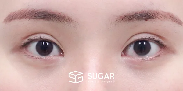 슈가성형외과 재) 재수술 + 절개(두 줄 따기) + 눈매교정 + 뒤밑트임 전후사진 - 수술 전