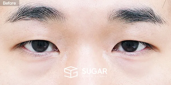 슈가성형외과 첫) 눈밑지방재배치 전후사진 - 수술 전
