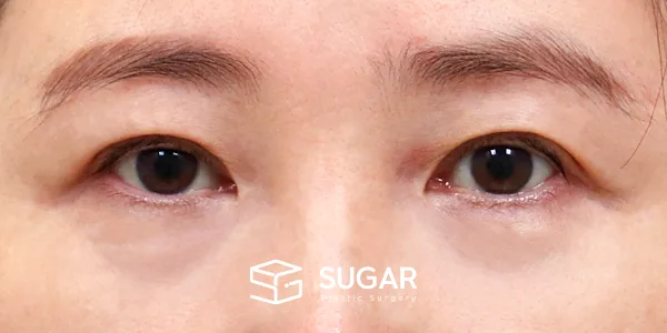 슈가성형외과 첫) 뒤밑트임 전후사진 - 수술 전