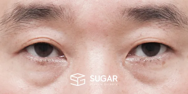 슈가성형외과 첫) 눈썹 거상 + 자연유착 + 눈 밑 지방 재배치 + 뒤밑트임 전후사진 - 수술 전