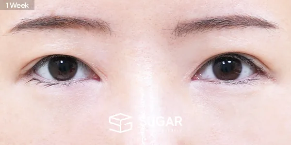 슈가성형외과 첫) 눈밑지방재배치 전후사진 - 수술 후