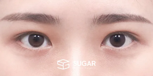 슈가성형외과 첫) 자연유착 + 눈매교정 전후사진 - 수술 후