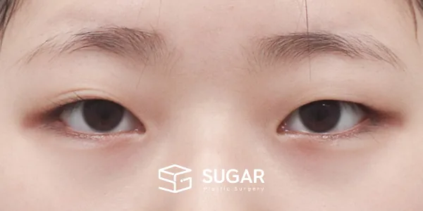 슈가성형외과 첫) 자연유착 + 눈매교정 전후사진 - 수술 전