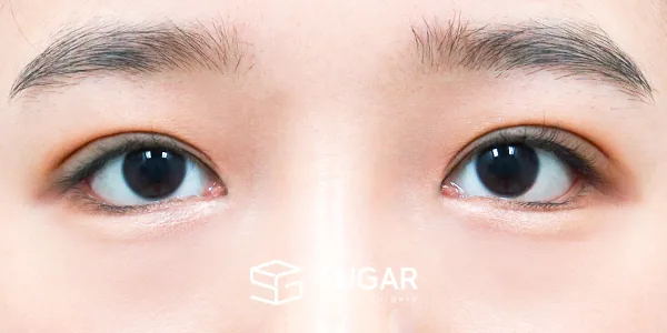 슈가성형외과 재) 자연유착 재수술 + 눈매교정 + 뒤밑트임 전후사진 - 수술 후