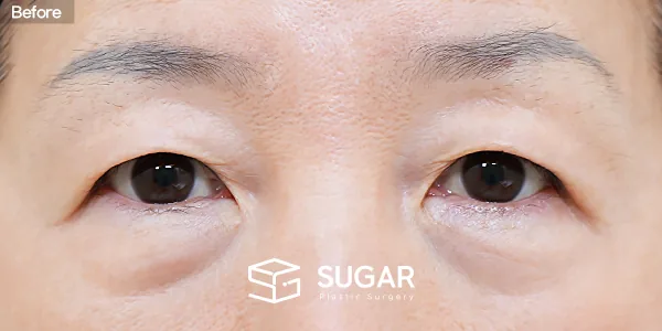 슈가성형외과 첫) 눈썹하거상술 + 하안검 전후사진 - 수술 전