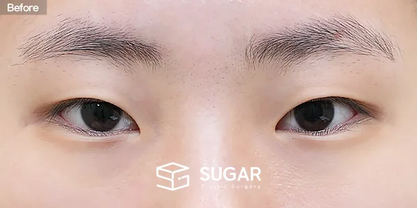 슈가성형외과 첫) 절개 + 눈매교정 + 앞트임 + 뒤밑트임 전후사진 - 수술 전
