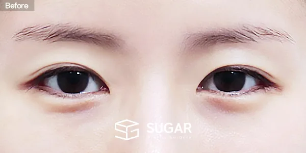 슈가성형외과 재) 재수술 + 자연유착 + 눈매교정 전후사진 - 수술 전