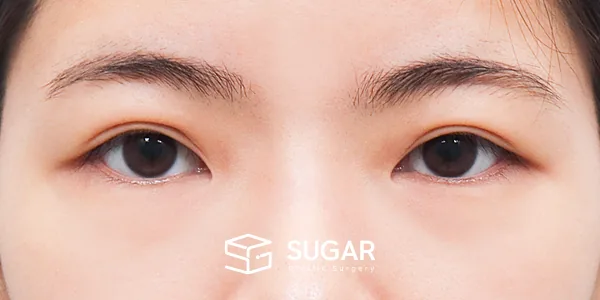 슈가성형외과 첫) 절개 + 윗트임 전후사진 - 수술 전