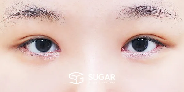 슈가성형외과 첫) 자연유착 + 눈매교정 + 앞트임 전후사진 - 수술 후